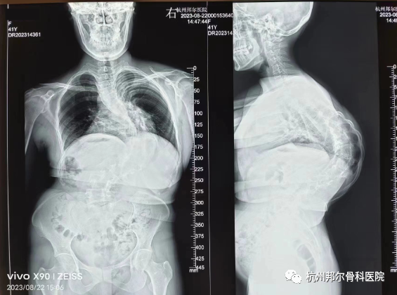 天玑机器人助力脊柱侧凸矫形手术， 41岁李阿姨挺直脊梁，重拾信心